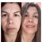 La imagen 1 de la Empresa MEDICINA ESTÉTICA DRA. NOELIA VILLENA Tratamiento para Celulitis en Morón AR-B