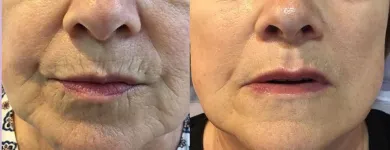 La imagen 2 de la Empresa DR.CAROLINA ODORICO MEDICINA ESTÉTICA Rejuvenecimiento Facial en Mendoza AR-M	